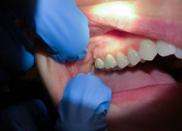 Emergency Gum Pain Relief in MD